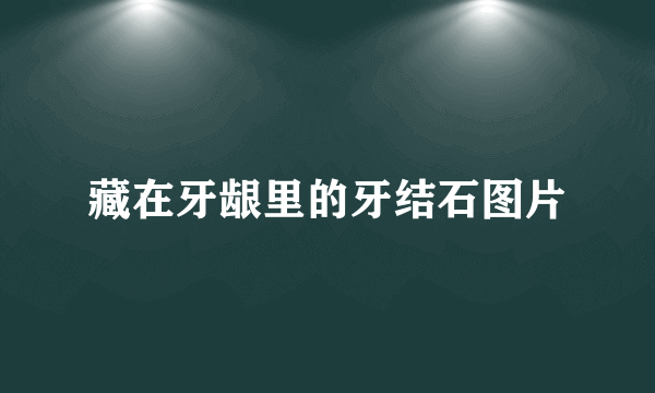 藏在牙龈里的牙结石图片