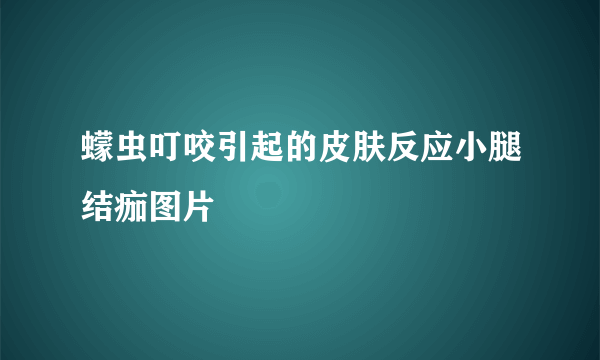 蠓虫叮咬引起的皮肤反应小腿结痂图片