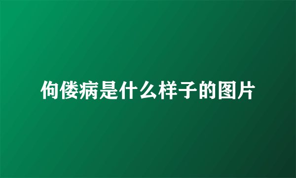 佝偻病是什么样子的图片