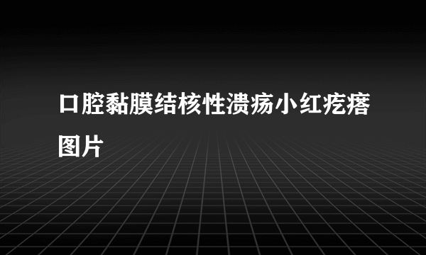 口腔黏膜结核性溃疡小红疙瘩图片