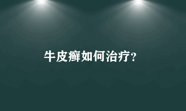 牛皮癣如何治疗？