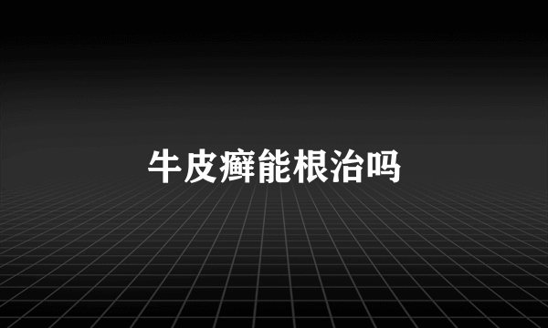 牛皮癣能根治吗