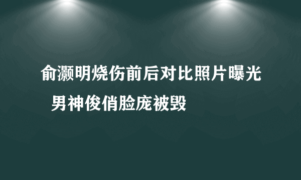 俞灏明烧伤前后对比照片曝光  男神俊俏脸庞被毁