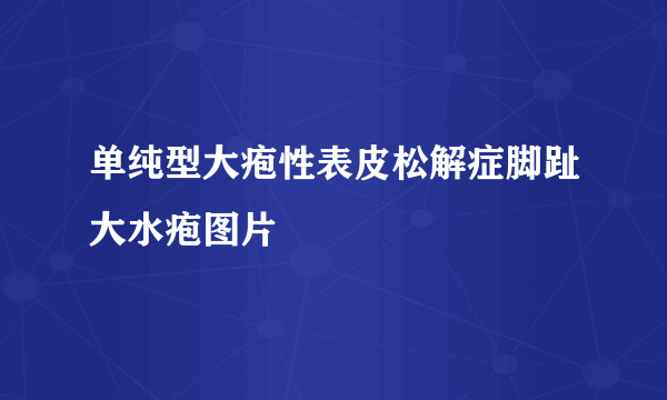 单纯型大疱性表皮松解症脚趾大水疱图片