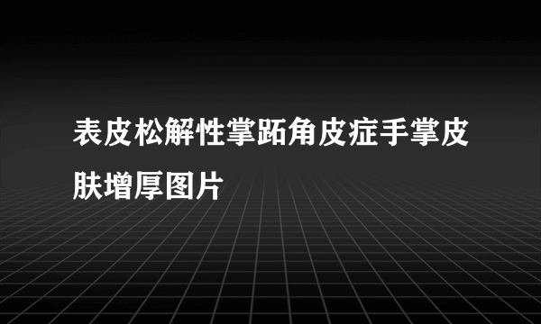 表皮松解性掌跖角皮症手掌皮肤增厚图片