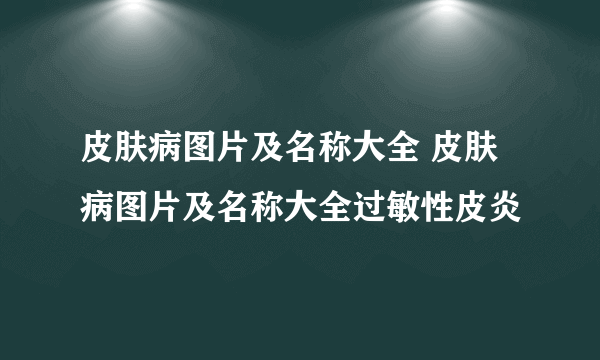 皮肤病图片及名称大全 皮肤病图片及名称大全过敏性皮炎